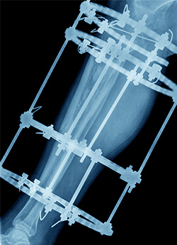 Radiografía de pierna con fijadores externos