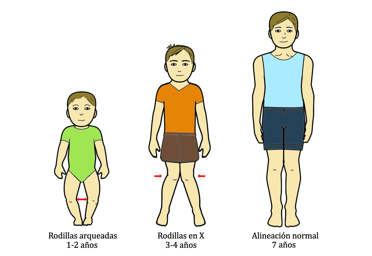 Diagrama niños varias edades con diferentes problemas en las rodillas