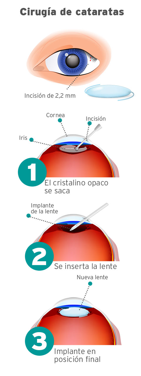 en-que-consiste-la-operacion-de-cataratas-sm