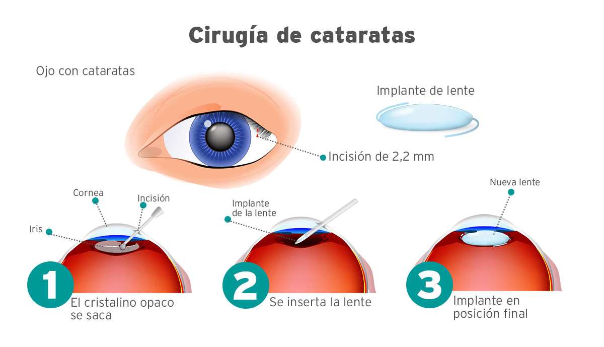 en-que-consiste-la-operacion-de-cataratas