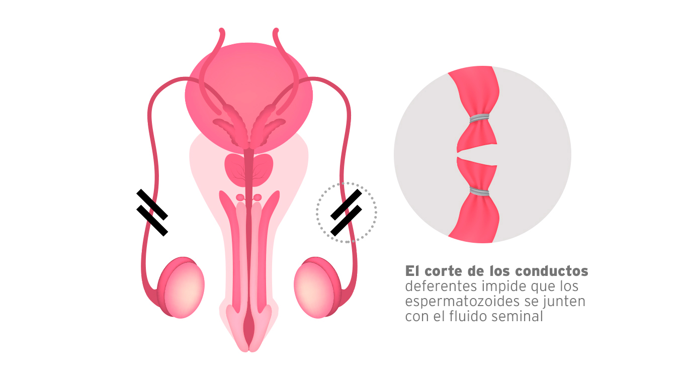 en-que-consiste-la-vasectomia
