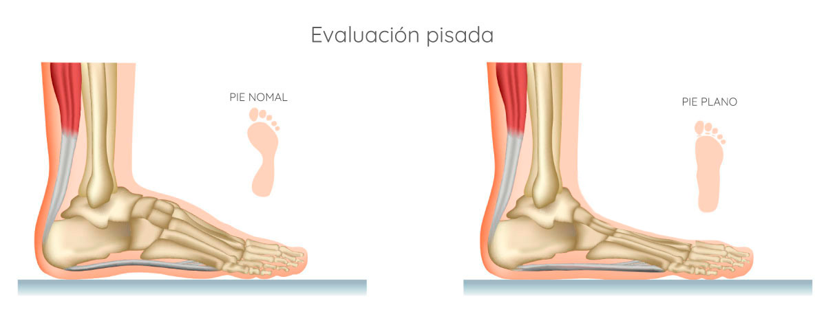 tipo de pisada pie plano pie normal