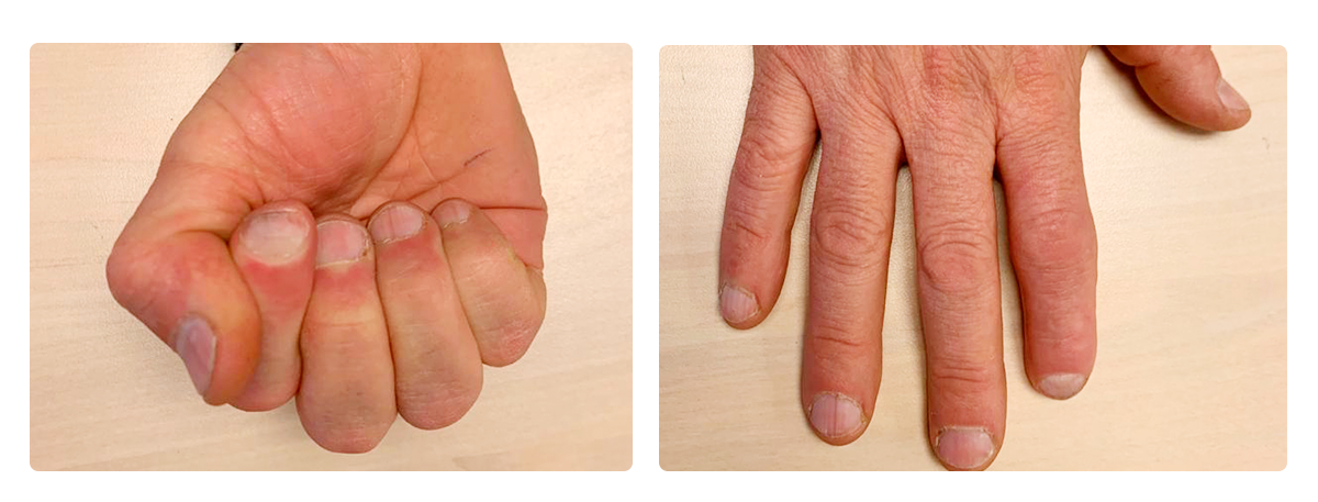cirugia-exitosa-de-alfredo-ugarte-recuperacion